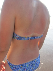 Kids, this is why we wear sunscreen, awesome potential tanlines aside.